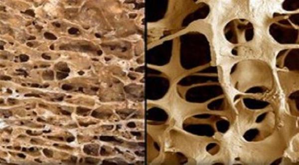 تطوير مواد طبيعية تسرع ترميم العظام  بأقل مضاعفات