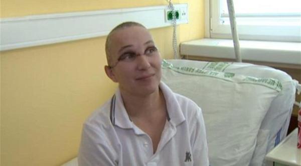 تشيكية فقدت فروة رأسها وشعرها بدأت بالتعافي