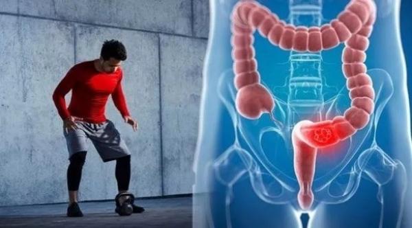 تمرين رياضي مهم يساهم في علاج سرطان القولون