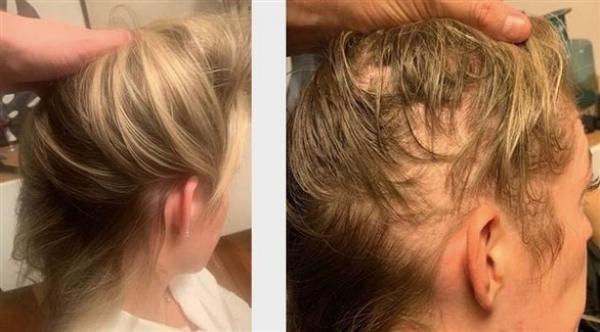 تتمكن من استعادة شعرها المتساقط بفضل مكمل غذائي لا يتجاوز ثمنه 29 دولاراً