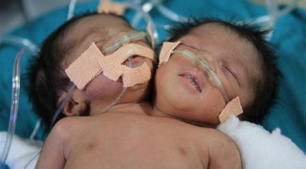 وفاة التوأم الهندي الملتصق قبل أن يتعرفا على والدتهما