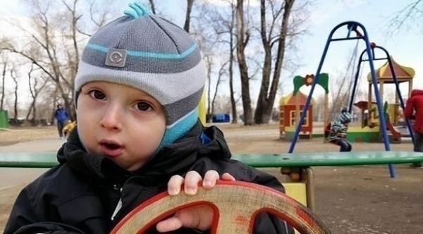 طفل يعاني من حالة مرضية نادرة تجعله يتحول إلى تمثال حجري حي