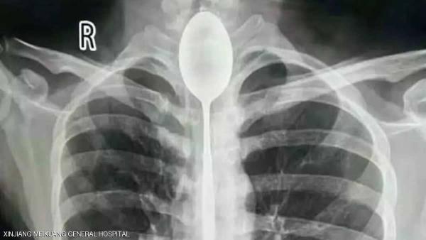 ملعقة بقيت داخل جسد رجل لمدة عام كامل