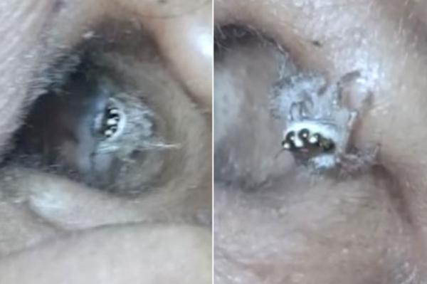 بالفيديو: عنكبوت يعشش داخل أذن امرأة لعدة أيام