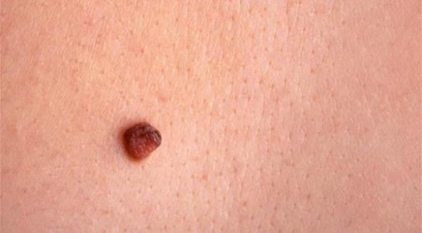 ما أسباب ظهور الشامات على الجلد؟