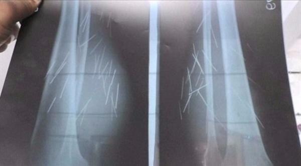 العثور على 70 إبرة داخل ساقي هذه المرأة