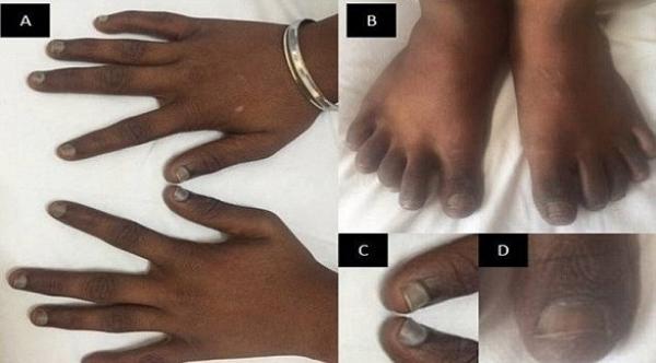 هذا ما يحدث عند نقص فيتامين بي 12