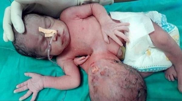 طفلة تولد برأس إضافي يتدلى من بطنها