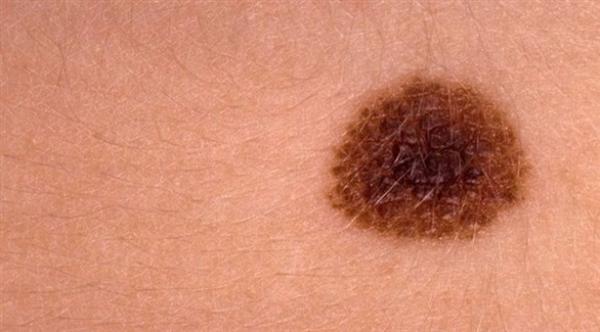 التغيرات الطارئة على الشامة... وتنذر بسرطان الجلد