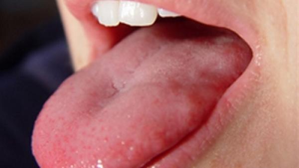 تعرف على مرضك من لون لسانك