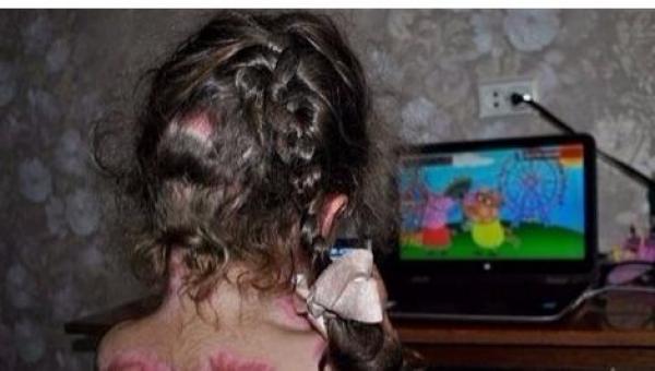 لعبة على الإنترنت تسبب حروقاً شديدة لطفلة في الخامسة