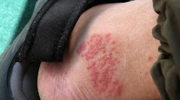 الحذاء قد يُصيبك بالحساسية التلامسية