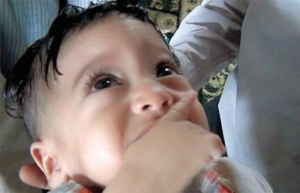 طفل يمني عمره 5 أشهر حامل بأخيه