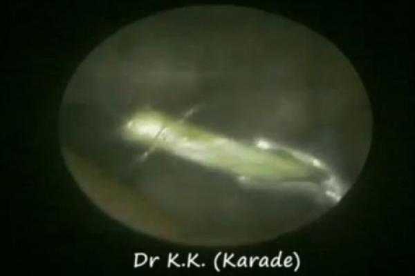 بالفيديو: لهذا السبب امتنع عن تنظف أذنيك بأعواد الثقاب