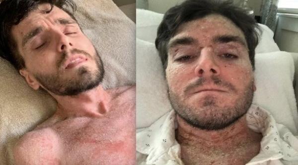 يعالج حساسيته بالامتناع عن الأدوية وشرب الماء