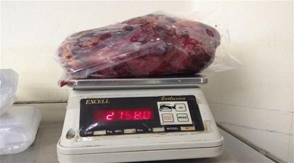 إزالة كليتين بحجم طفل رضيع من جسد رجل هندي