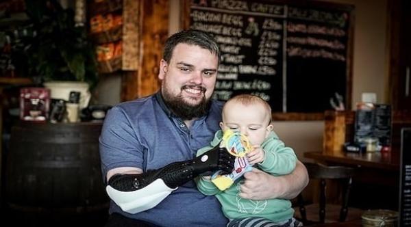 يتمكن من الاعتناء بطفله بفضل ذراع روبوتية قيمتها  12 ألف دولارا