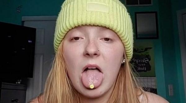 حالة نادرة تتسبب في نمو الشعر بلسانها