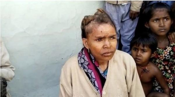 امرأة هندية بملامح تشبه القرون تسبب  لها ألماً لا يطاق