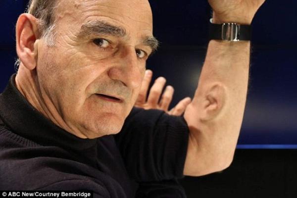 بالفيديو: فنّان يزرع أذناً في ذراعه ليوصلها عبر الإنترنت