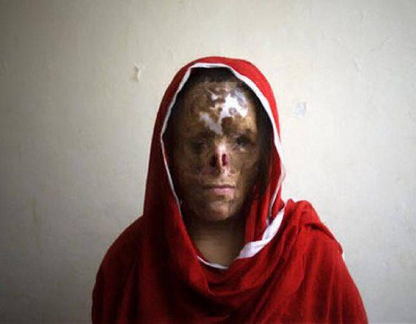 تفاصيل صادمة: قاصر مغربي يتعرض لاعتداء خطير باسبانيا..شخص مُقنع شوه وجهه بمادة حارقة