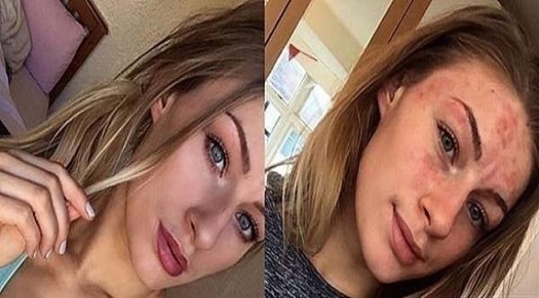 بالصور: تحدي جديد على الإنترنت لإظهار عيوب البشرة