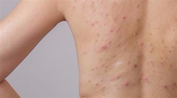 لماذا تظهر بثور على الظهر؟