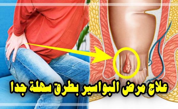 علاج مرض البواسير بطرق تقليدية وسهلة جدا في متناول الجميع