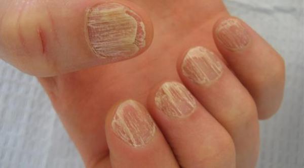 8 علامات على نقص الفيتامينات والمعادن