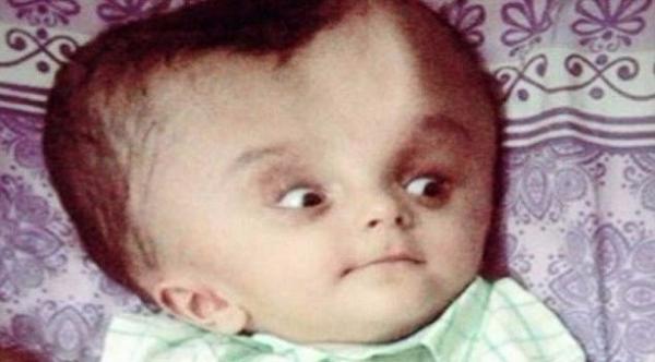 عملية جراحية لطفل ولد برأس مشوه بفضل متبرع مجهول