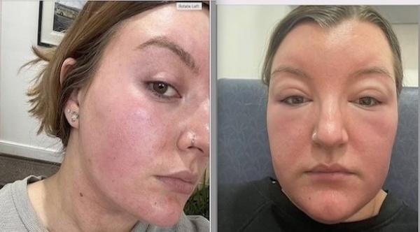 ينتفخ وجهها بسبب نسيان وضع الواقي الشمسي