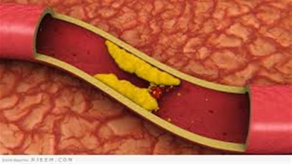 خلطة سحرية تخلصك من الكوليسترول نهائيا في أسبوع