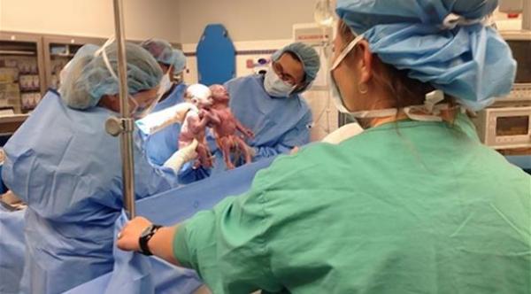 طفلتان توأم تخرجان من رحم والدتهما ماسكتا أيدي البعض