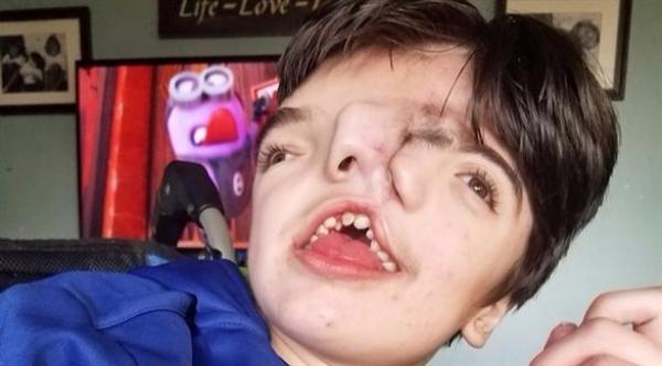 طفل بوجهين يخالف توقعات الأطباء