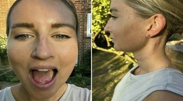 إعادة بناء لسان امرأة  باستخدام عضلة من ساقها