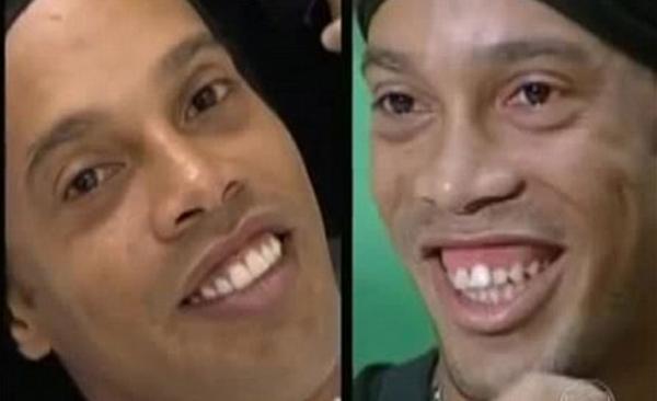 شاهد..ماذا فعل الأطباء بأسنان رونالدينيو