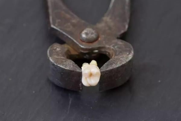 يضطر لخلع أسنانه بنفسه بعد فشله فى حجز موعد مع الطبيب لمدة 10سنوات