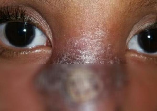 خطير بالفيديو... وباء "اللشمانيا" يفتك بأطفال هذه المنطقة والاباء وأطفالهم يطلقون نداء استغاثة