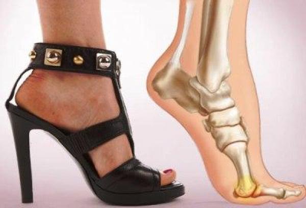 ضريبة الكعب العالي.. كسور في العظام والتواء بالكاحل