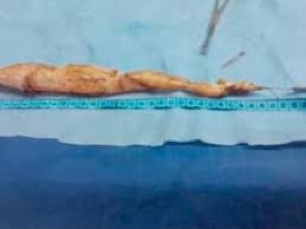 بالفيديو: إزالة أطول مرارة في العالم بطول 30 سم