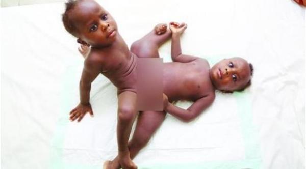 السعودية تشهد اليوم أعقد عملية فصل توأم سيامي