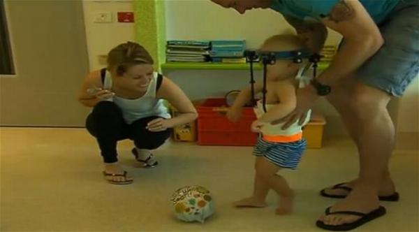 جراحون يعيدون رأس طفل مفصول إلى مكانه