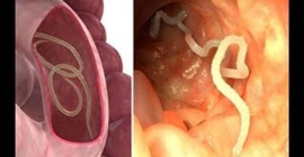 علاج فعال للتخلص من «ديدان الأمعاء» في 3 أيام (فيديو)