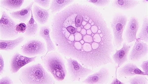 باحثون يبتكرون تقنية جديدة لإضاءة الورم السرطاني أثناء الجراحة