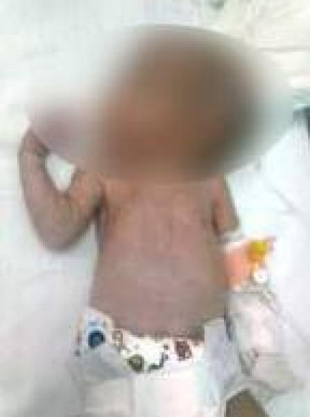 الدار البيضاء : رضيع يدخل المستشفى بسبب الإسهال ويخرج منها مبتور اليد