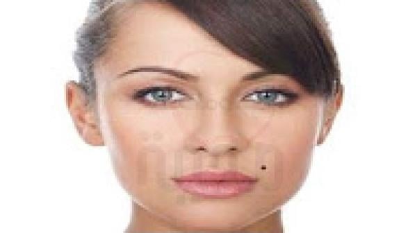 هكذا تعرفين إذا كانت الشامة في جسمك حميدة أم خبيثة