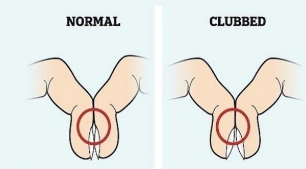 طريقة بسيطة يمكن اتباعها في بيتك للكشف عن سرطان الرئة