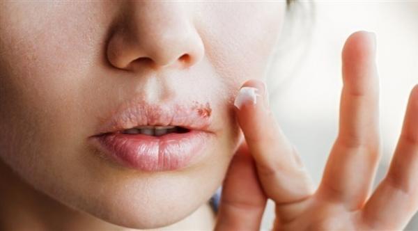 هربس الوجه فيروس يعود إلى 5 آلاف سنة