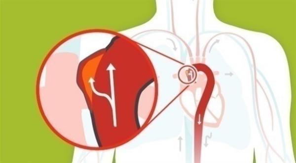 فرص نجاة المريض بعد تمزق الشريان الأورطي تحسنت بشكل ملحوظ