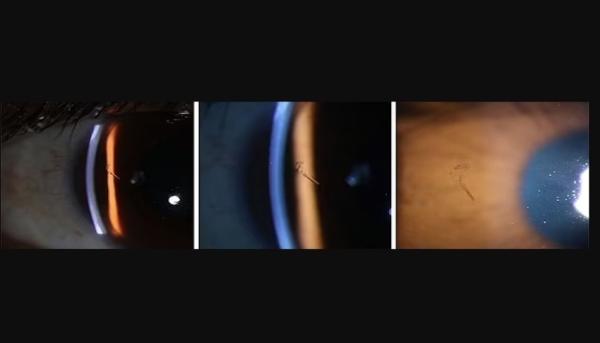 أطباء يعثرون على شظية خشبية مدفونة في قرنية عين رجل منذ 15 عاماً